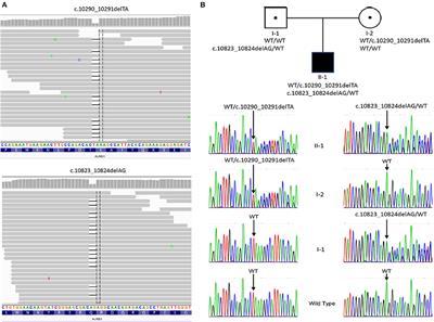 Rare Compound Heterozygous Frameshift Mutations in ALMS1 Gene Identified Through Exome Sequencing in a Taiwanese Patient With Alström Syndrome